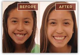 Braces before and after pictures in virginia beach, va. Before After Braces