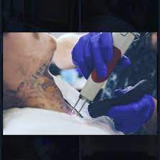 Laser tattoo removal with picosure starting at $100.00 picosure's 755 wavelength effectively treats blacks, blues and greens, and now the new 532 nm wavelength more effectively treats red, orange, and yellow tattoo ink colors. Reno Tattoo Removal Home Facebook