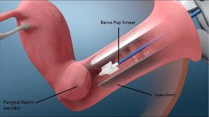 Pap smear, juga disebut tes pap, adalah prosedur skrining untuk mendeteksi kanker serviks. Ujian Pap Smear Apa Yang Anda Perlu Tahu The Diagnosa