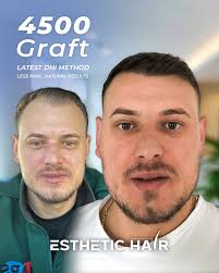 Turkish Hair Transplant in Cancun/Mexico