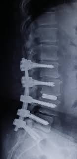 Chirurgia della colonna vertebrale - Chirurgia protesica delle grandi articolazioni - Chirurgia delle metastasi ossee