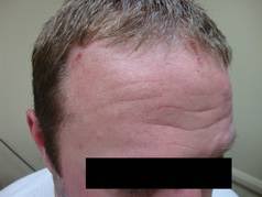 Image result for Neurotic Excoriation