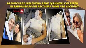 Theres always room for improvement! Aj Pritchard S Girlfriend Abbie Quinnen Is Wrapped In Bandages As She Recovers From Fire Accident Youtube