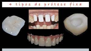Protese Fixa 4 Tipos Diferentes Youtube