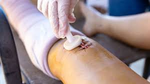 Image result for Wound