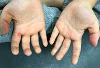 Get your query answered 24*7 only on | practo consult. Peeling Of The Palmar Surface Of The Fingers Medicine Today