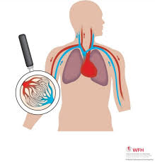 Aflati mai multe despre hemofilia a din materialul urmator. Atencion Recomendada Para El Paciente Con Hemofilia Ante El Covid 19 El Medico Interactivo