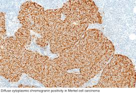 A panel of antibodies including cytokeratins 20, 7 and epithelial membrane antigen, and. Pathology Outlines Merkel Cell Carcinoma