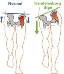 5 Patellofemoral Pain Syndrome Exercises For Healthy Knees Precision Movement