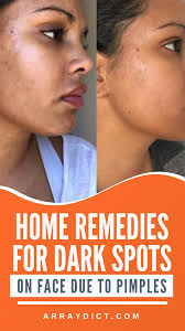 Home Remedies For Dark Spots On Face Due To Pimples In 2020 Dark Spots On Face Spots On Face Dark Spots On Skin