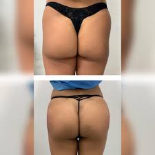 How can i get longest lasting bbl results? Sculptra Butt Lift Toronto Non Surgical Butt Augmentation Mississauga Skinatomy Laser Clinic