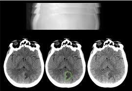 Low Dose Ct Image And Projection Data Ldct And Projection Data The Cancer Imaging Archive Tcia Public Access Cancer Imaging Archive Wiki