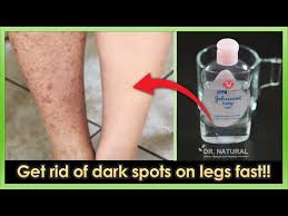 Today we are going to talk about how to get rid of dark spot on your legs and all over your body fast i'm going to. How To Get Rid Of Dark Spots Scar Mosquito Bites Hyperpigmentation On Legs Fast Youtube
