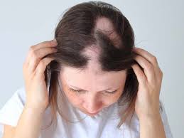 Image result for Alopecia