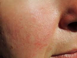 .rosacea — global diversity and optimized outcome: Acne Rosacea Treatment 6 Reasons Not To Wait Coral Springs