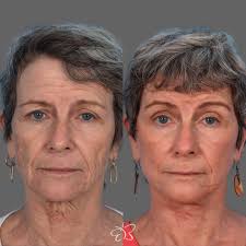 Buckingham Center for Facial Plastic Surgery