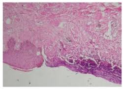Maybe you would like to learn more about one of these? Fournier S Gangrene Intechopen