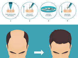 Haartransplantation für frauen, haarwuchsmittel, haarteile und perücken. Fue Haartransplantation Methode Haarausfall Hilfe