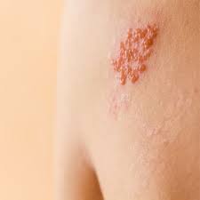 Image result for herpes zoster