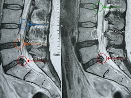Vor allem sollte vor der anfertigung von einem mrt dringend. Mrt Erhalten Und Immer Noch Keinen Durchblick Myspinalcoach