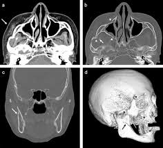 Image result for Coronoid Process Fracture