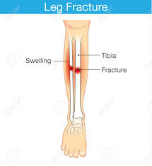 Browse 7,069 leg bone stock photos and images available, or search for human leg bone or leg bone xray to find more great stock photos and pictures. Diagram Of Leg Have Bone Fracture This Illustration Have Description Of Inner Leg Composition Royalty Free Cliparts Vectors And Stock Illustration Image 50016198