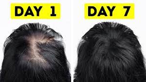 However, this last time, after spending a lot of money and time trying to find something to not only disguise my thin hair but to help it grow back faster, i finally found something that is working! I Went From Thin To Thick Hair In Just A Week Youtube