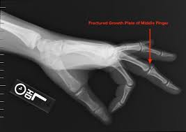 Image result for Hand Growth Plates