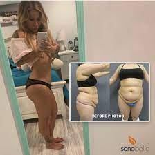 Check spelling or type a new query. Trisculpt Micro Laser Liposuction 10 Things You Need To Know