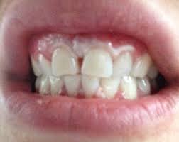Pin On Teeth