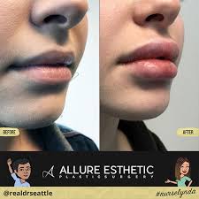 Today, i'm going to be talking about different lip filler techniques and how to achieve a natural look. Lip Augmentation Seattle Lip Injection Bellevue