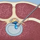 Dr sahil's advanced physiotherapy clinic. Surgery For A Herniated Disc Weill Cornell Brain And Spine Center