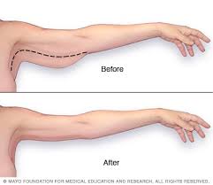 Maybe you would like to learn more about one of these? Arm Lift Mayo Clinic