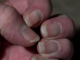Advances in chronic kidney disease. Signs Of Disease In The Nails