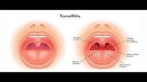 Check spelling or type a new query. Food Stuck In Throat When You Can Still Breathe Green Host It