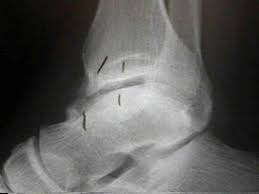 Bone spurs (osteophytes) often form where bones meet each other — in your joints. Anterior Impingement Syndrome Of The Ankle Wheeless Textbook Of Orthopaedics