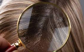 9 Ways To Get Rid Of Dandruff Skinkraft