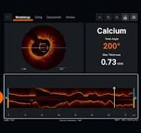 Optical Coherence Tomography (OCT) Intravascular Imaging ...