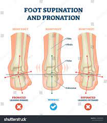 Foot Supination And Pronation Vector Illustration Labeled Medical Scheme With Incorrect Leg Joint Movement Educational Vector Illustration Illustration Feet