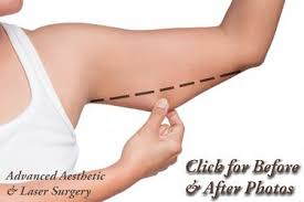For the most part, loose, flabby skin contains fat. The Difference Between An Arm Lift And Liposuction Columbus Oh