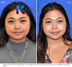 For patients of african, asian, middle eastern and all other ethnic descents, the goal is improving their appearance without diminishing their ethnicity. Asian Rhinoplasty Before After Gallery Dr Kolstad San Diego Facial Plastic Surgeon