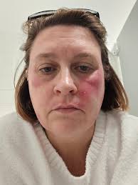 Do you suffer from acne, eczema, or rosacea?