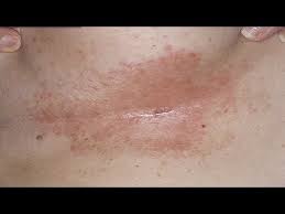 How to get rid of rash under breast. How To Get Rid Of Dry Flaky Skin In Between Breast Dr Aruna Prasad Acanthosis Nigricans Under Breast