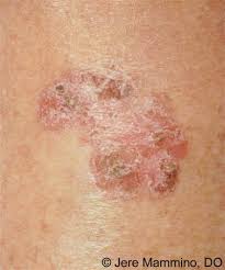 Be reassured that skin tags are not usually skin cancer and they do not turn into skin cancer if they are left untreated. Bowen S Disease American Osteopathic College Of Dermatology Aocd