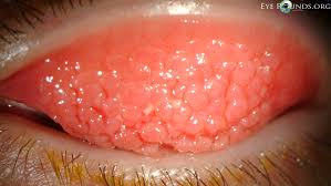Image result for Vernal Conjunctivitis