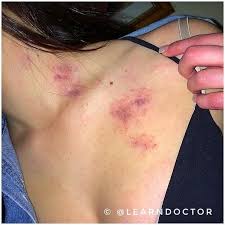 👨‍⚕️HICKEYS (so called Love bites 👄) - These are dark red or purple  bruises on the skin caused by light biting or suction by a lover. The  suction can result in the
