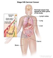Cervical cancer wouldn't necessarily explain you feeling unwell and experiencing the sort of symptoms you're describing but a smear test is. Cervical Cancer Treatment Pdq Treatment Patient Information Nci Cs Mott Children S Hospital Michigan Medicine