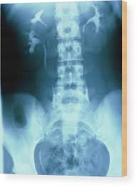 Image result for Intravenous Pyelogram