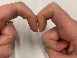 Finger clubbing: An easily forgotten red flag - GatewayC