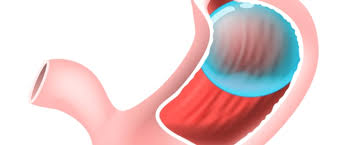 بالون المعدة كل ما عليك معرفته ويب طب